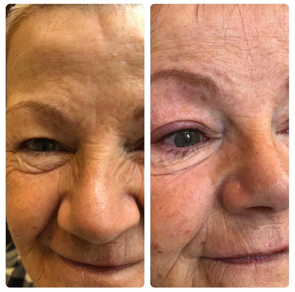 Laser removal of eyebrow microblading, lip tattooing and eyeliner
